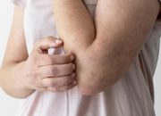Psoriasis Berbeda dari Eczema Meskipun Gejalanya Mirip, Kenali 6 Ciri Khasnya