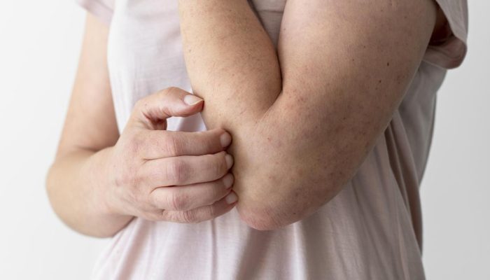Psoriasis Berbeda dari Eczema Meskipun Gejalanya Mirip, Kenali 6 Ciri Khasnya